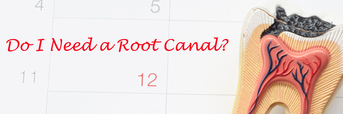 Many Do I Need a Root Canal