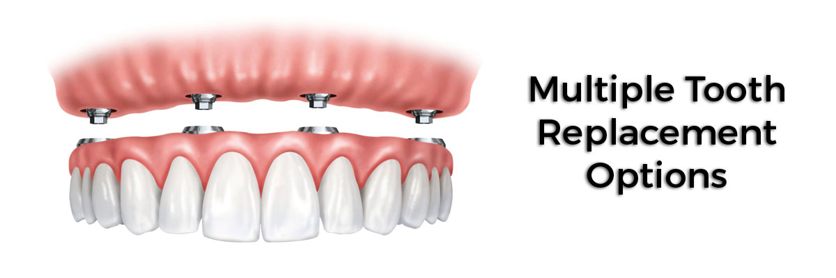 Many Multiple Teeth Replacement Options