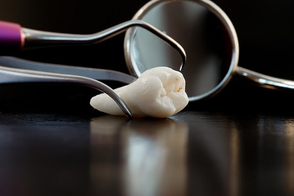 Wisdom Teeth: Should They Be Removed?